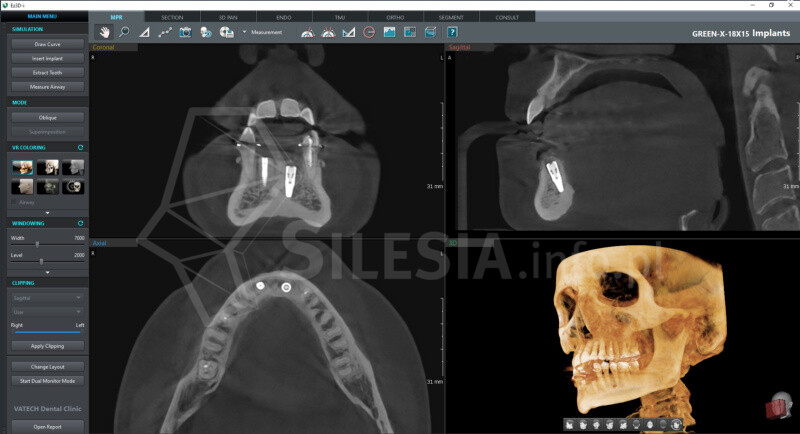 RTG stomatologiczne, CBCT od 100 zł Świętochłowice